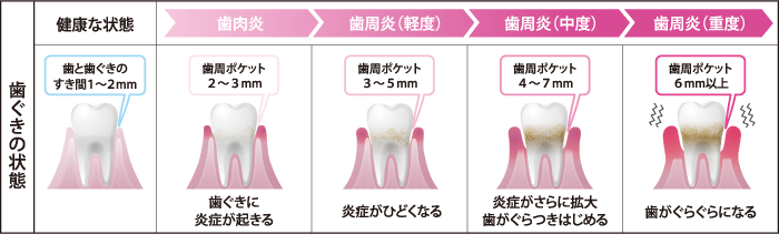 あなたも歯周病かも 正しい知識と毎日のセルフケアが重要 Tomoko ドラッグストア トモズのライフスタイルナビゲーター